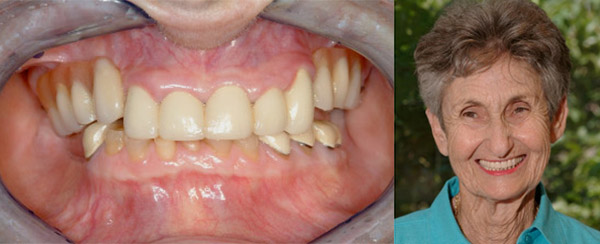 Smile Makeovers TeethToday Dental Implant Center