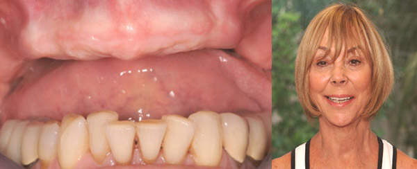 Smile Makeovers TeethToday Dental Implant Center