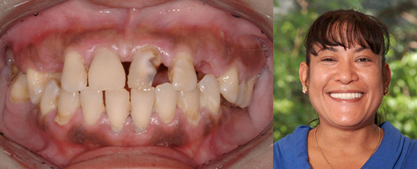 Smile Makeovers TeethToday Dental Implant Center